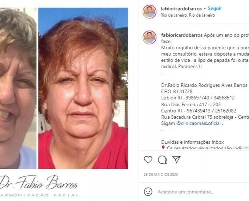 harmonização facial é definitivo?