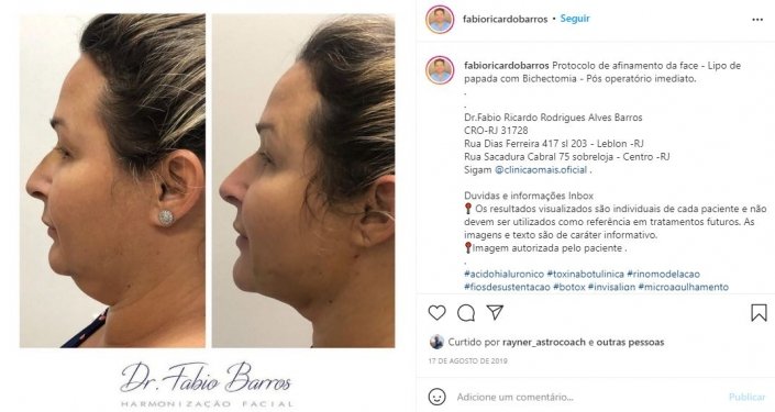 harmonização facial é definitivo?