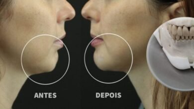 harmonização facial é definitivo?