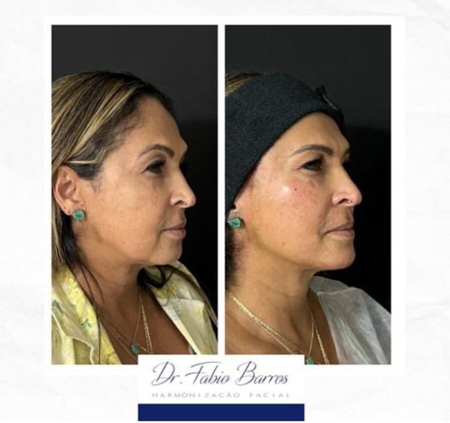 Harmonização Facial