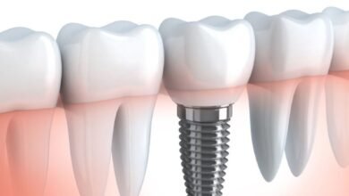 O que são implantes dentários e para que servem?