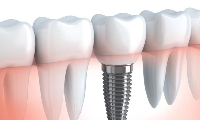 O que são implantes dentários e para que servem?