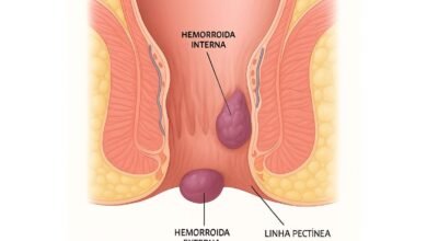 Hemorroida Externa