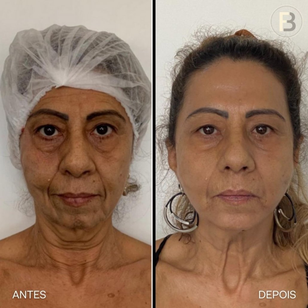 Explorando a Harmonização Facial: Um Guia Completo