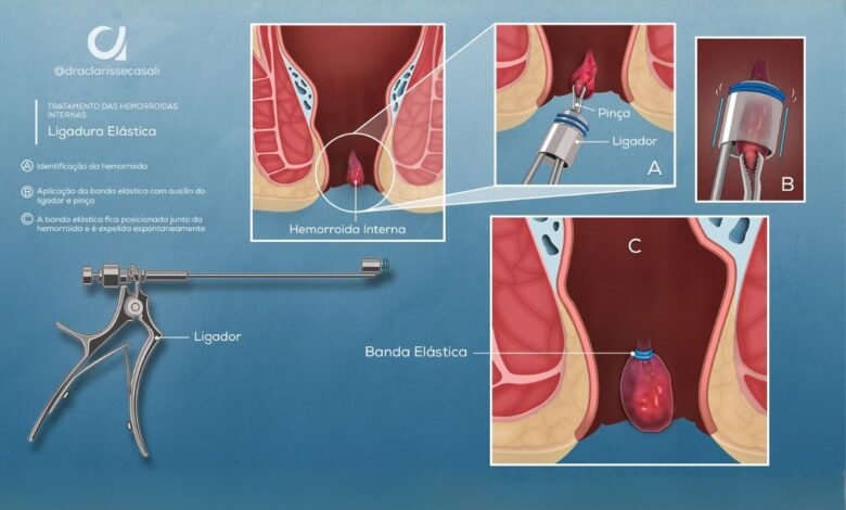 Ligadura Elástica para Hemorroidas: O Tratamento Ambulatorial de Primeira Escolha (Graus I a III)