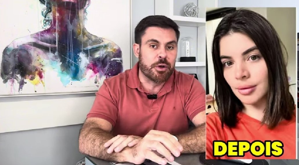 Excesso de preenchimento com ácido hialurônico