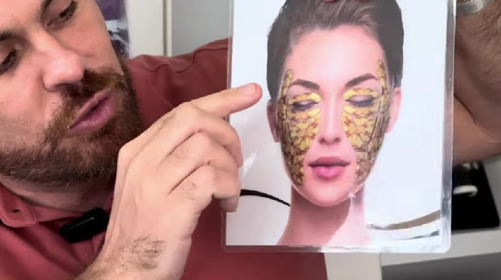 Excesso de preenchimento com ácido hialurônico