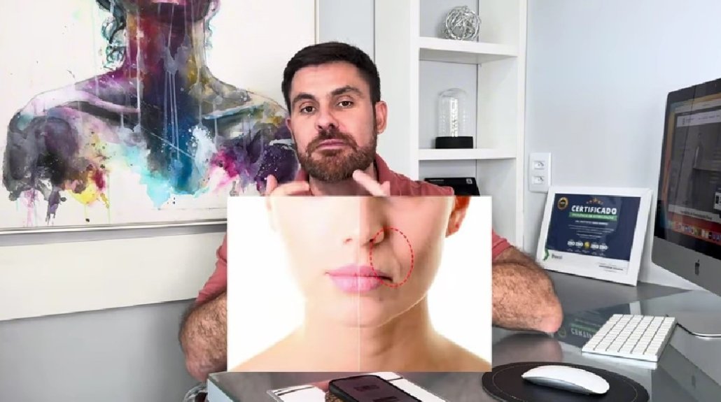 Excesso de preenchimento com ácido hialurônico