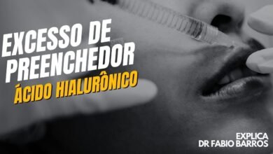 Excesso de preenchimento com ácido hialurônico