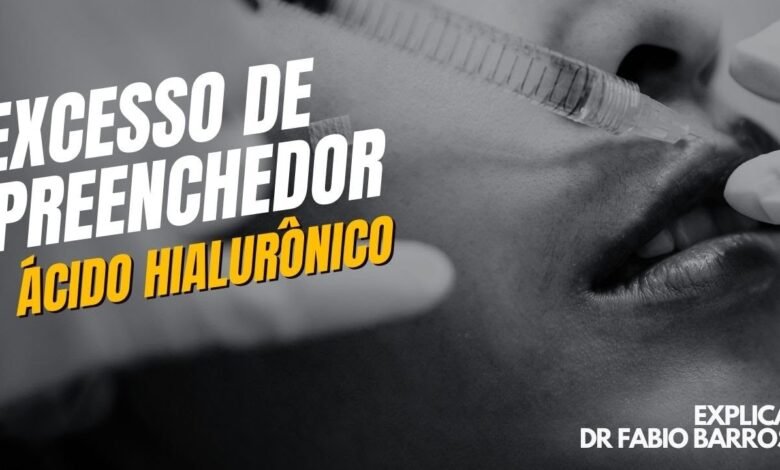 Excesso de preenchimento com ácido hialurônico