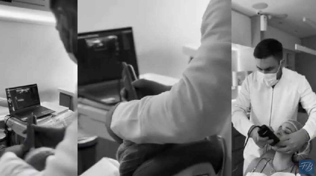 É possível realizar o preenchimento com ácido hialurônico em pacientes com PMMA?