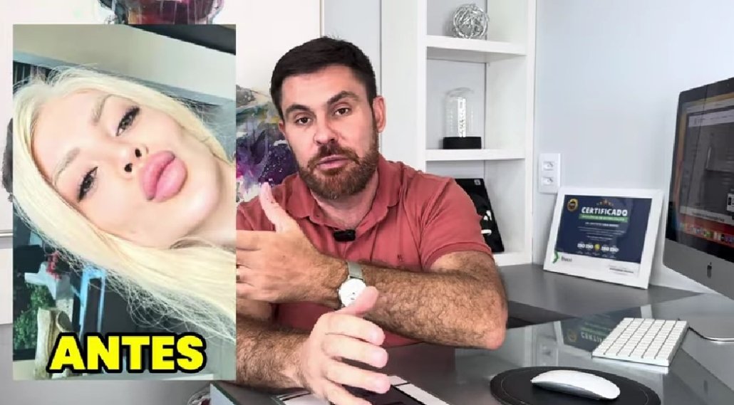 Excesso de preenchimento com ácido hialurônico