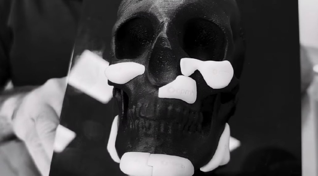 Harmonização facial definitiva - Prótese Facial