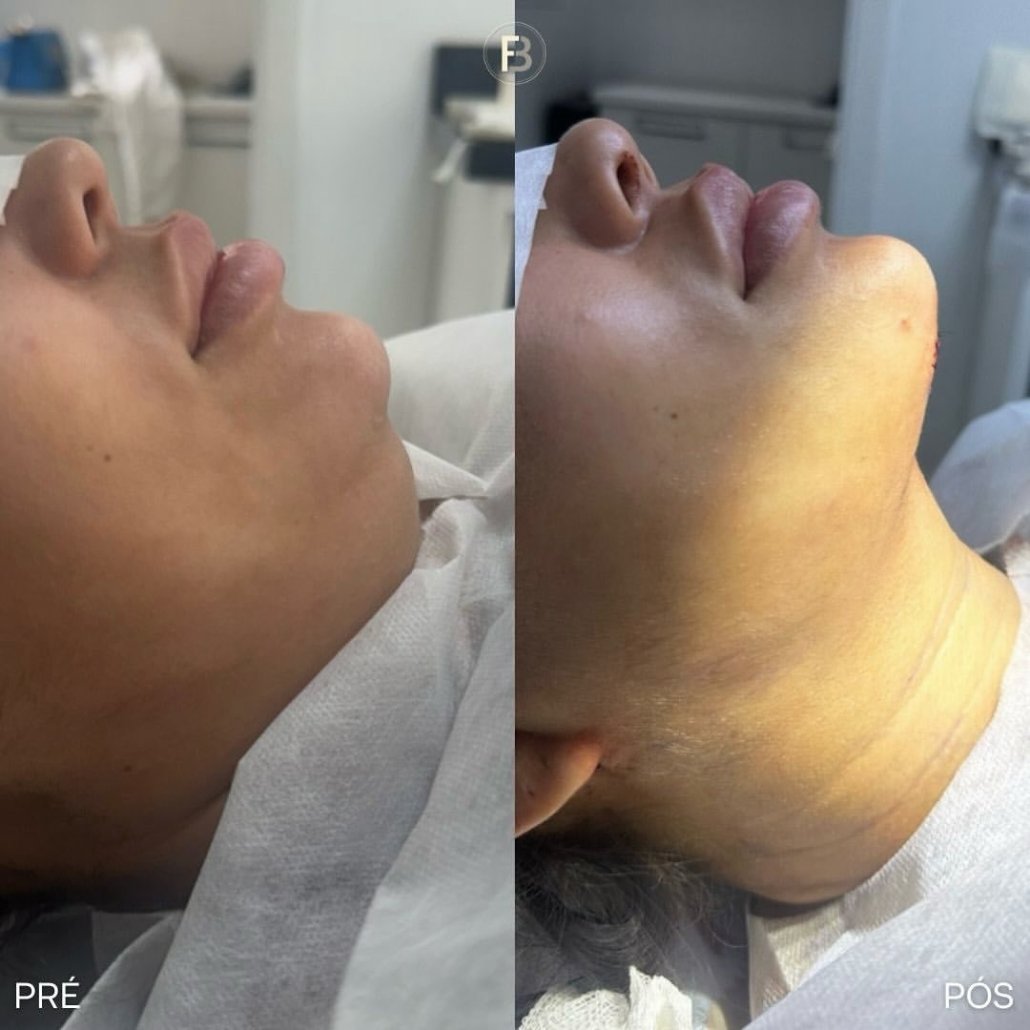 Entendendo a Platismoplastia: Um Caminho para o Rejuvenescimento do Pescoço