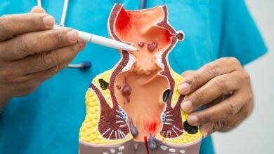 Hemorroidas: graus 1 a 4, sintomas e tratamentos (do consultório à cirurgia)