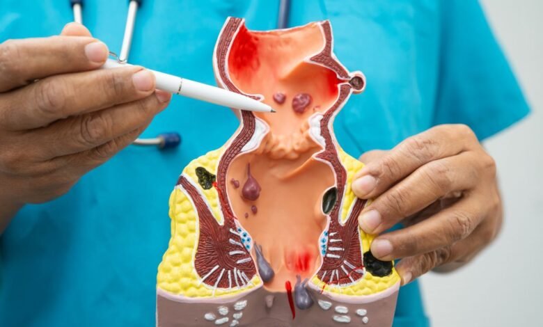 Hemorroidas: graus 1 a 4, sintomas e tratamentos (do consultório à cirurgia)